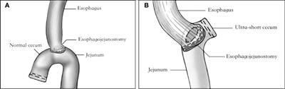 An improvement in the reconstruction of digestive tract after total gastrectomy: ultra-short cecum